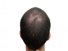 Hair Replacement